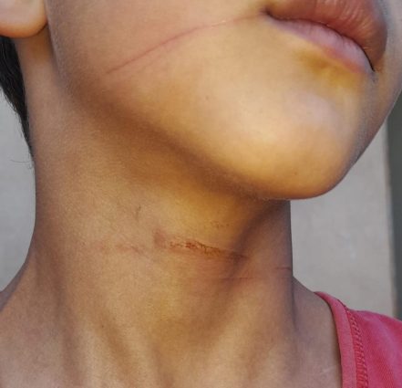 Garoto de 8 anos é atingido por linha com cerol, cai da bicicleta e quase é atropelado em Água Clara (MS)